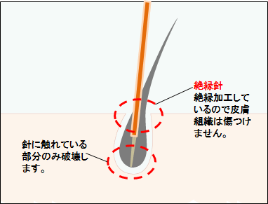 ニードル脱毛