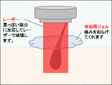 レーザー脱毛